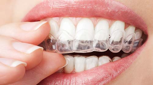 Invisalign für Patienten aus Itzehoe